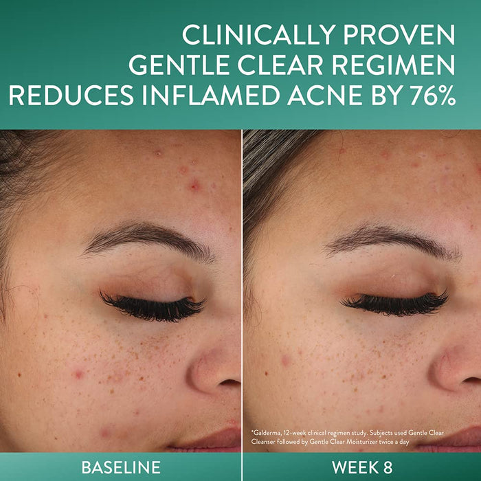CETAPHIL Gentle Clear Mattifying Acne Moisturizer Salicylic Acid Acne Treatment كريم الساليسيلك اسد لللبشرة
