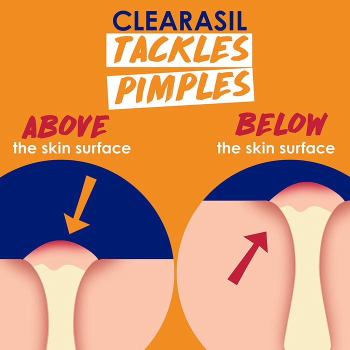 CLEARASIL Stubborn Acne Control 5 In 1 Spot Treatment Cream كريم موضعي لعلاج حبوب البشرة