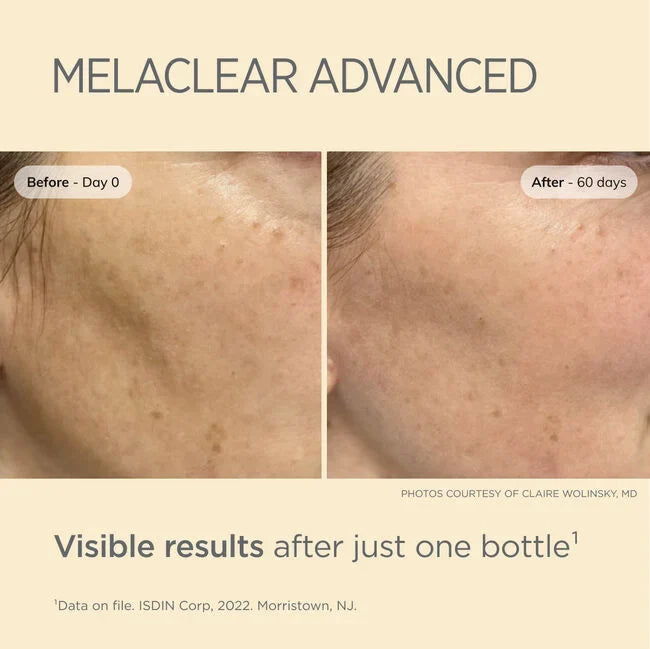 Melaclear Advanced before-and-after skin tone results showing reduced dark spots after 60 days