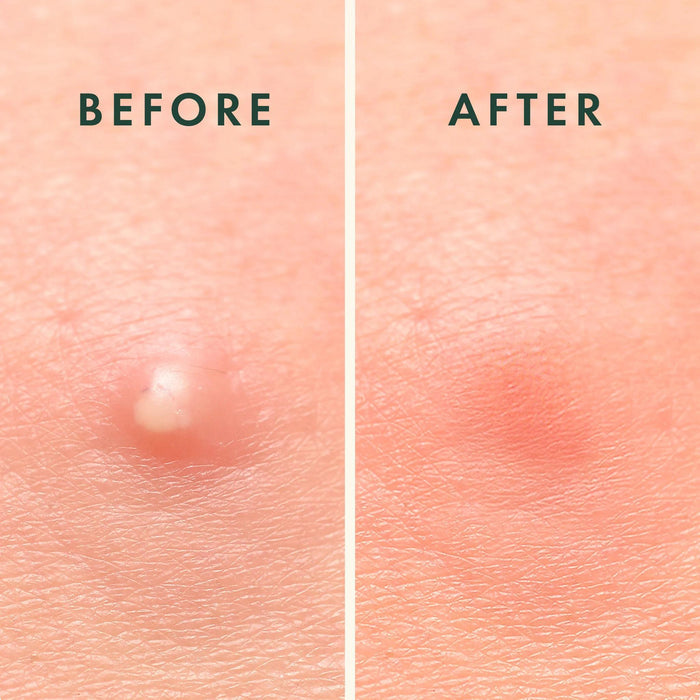 Rael Miracle Patch Overnight Spot Cover - Pimple Patch Acne 52 patches