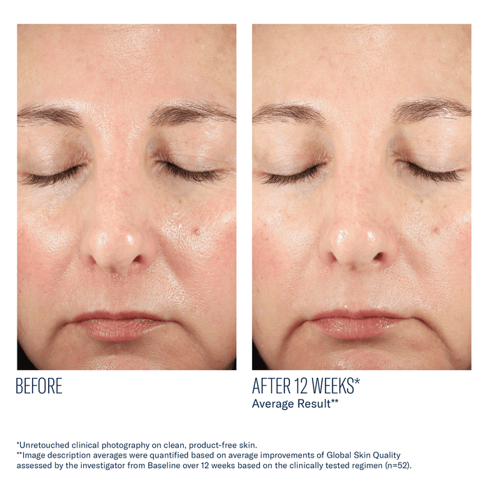 Before and after face results after 12 weeks with improved skin tone and texture
