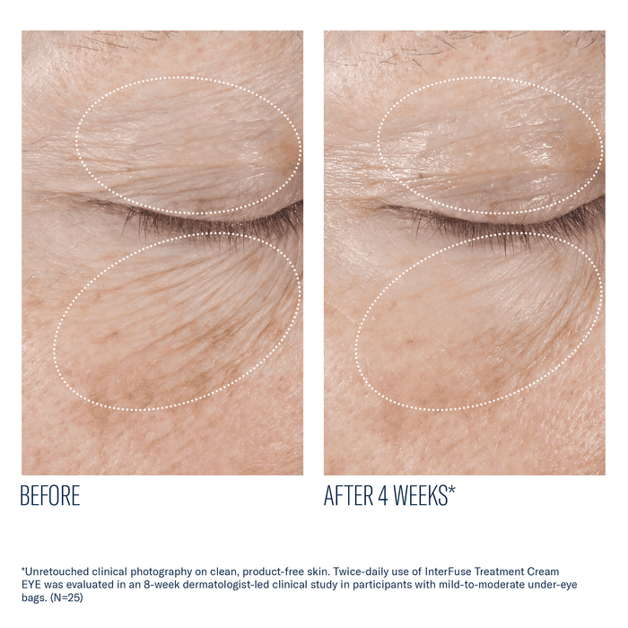 Before and after 4 weeks of skinbetter InterFuse Treatment Cream EYE reducing under-eye bags and wrinkles