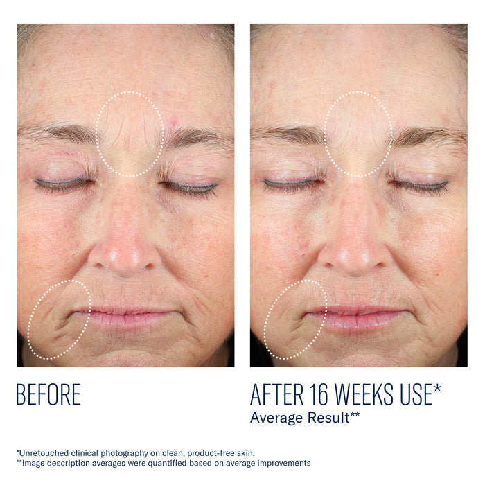 Before and after 16 weeks of skinbetter Mystro Revive serum use, showing smoother forehead and smile lines