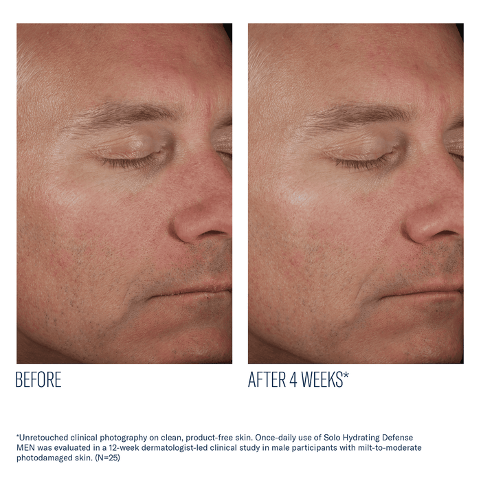 Before and after 4 weeks of skinbetter Solo Hydrating Defense MEN on male facial skin