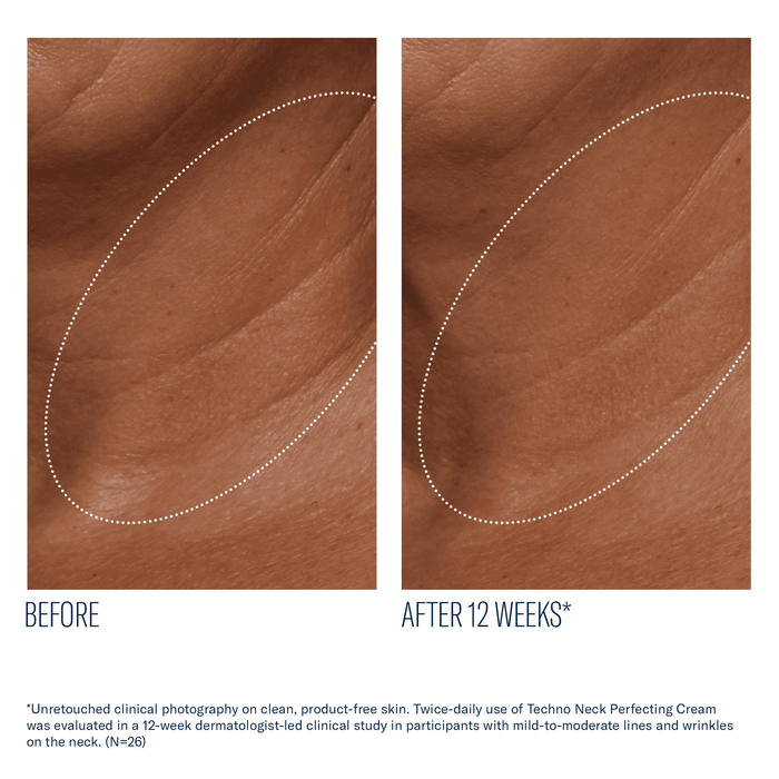 Before and after 12 weeks neck skin comparison for skinbetter Techno Neck Perfecting Cream