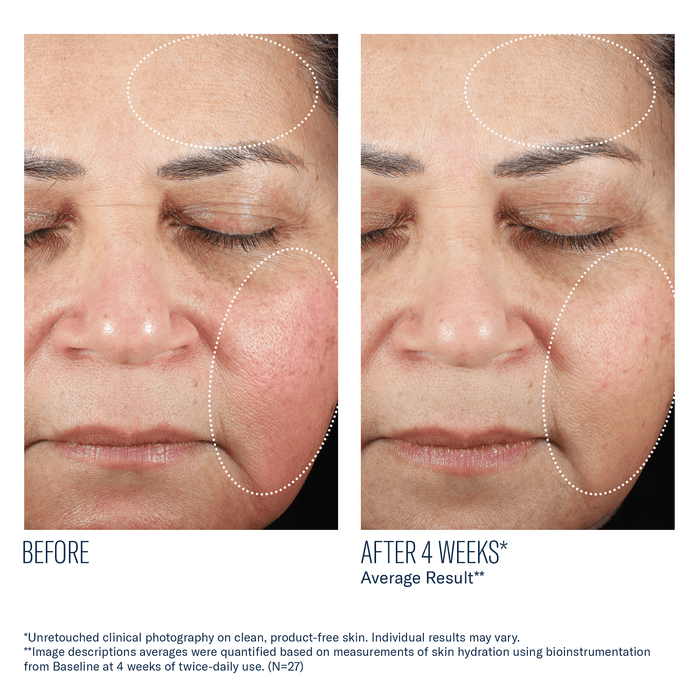 Before and after 4 weeks showing reduced redness and improved skin texture on cheek and forehead