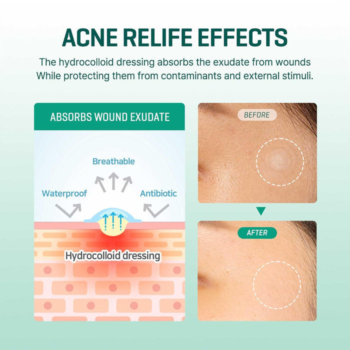 SOME BY MI 30 Days Miracle Clear Spot Patch 18 pcs